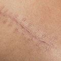 Recovering from Aesthetic Surgery: What to Expect and How to Care for Your Wound