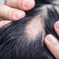 Understanding Alopecia: Causes, Types, and Treatment Options