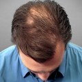 Understanding Medical Treatments for Male Pattern Baldness