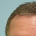 A Comprehensive Look at Finasteride for Aesthetic Surgery