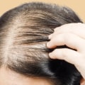 Lifestyle Factors and Female Hair Loss: Understanding the Connection