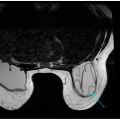 Understanding Implant Rupture and Displacement