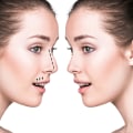 All You Need to Know About Rhinoplasty