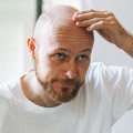 Exploring the Link Between Lifestyle Factors and Male Pattern Baldness