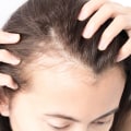 Understanding Female Hair Loss: Causes, Diagnosis, and Treatment