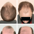 Diagnosing Male Pattern Baldness: A Comprehensive Guide