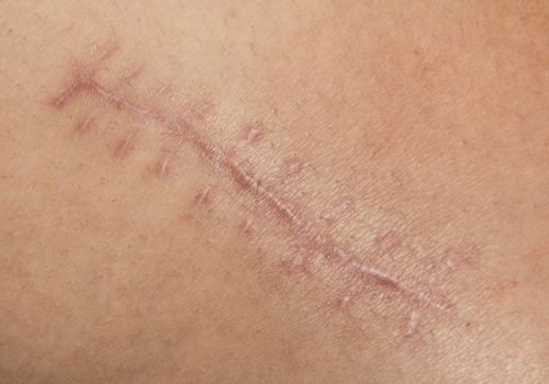 Recovering from Aesthetic Surgery: What to Expect and How to Care for Your Wound