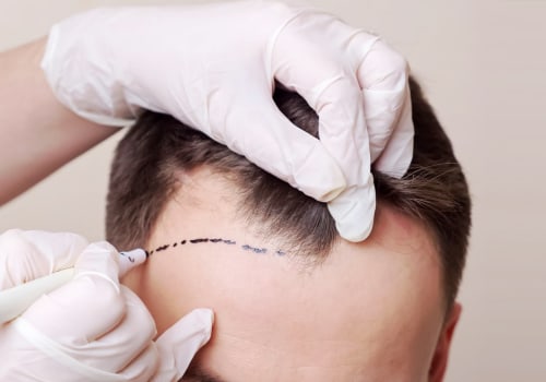 All You Need to Know About Hair Transplants