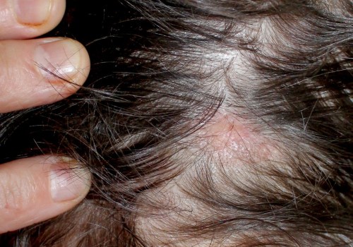 Understanding Medical Conditions and Female Hair Loss: What You Need to Know