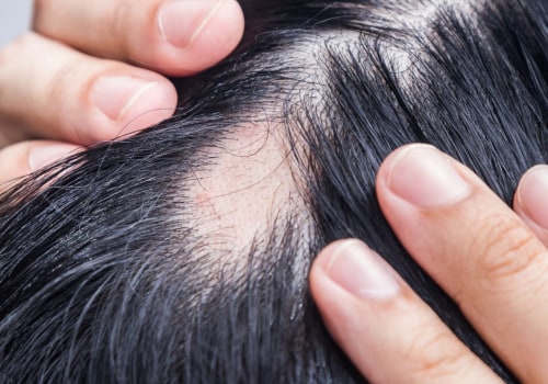 Understanding Alopecia: Causes, Types, and Treatment Options