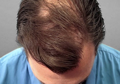 Understanding Medical Treatments for Male Pattern Baldness