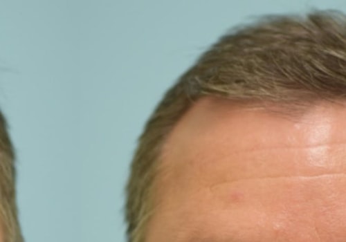 A Comprehensive Look at Finasteride for Aesthetic Surgery