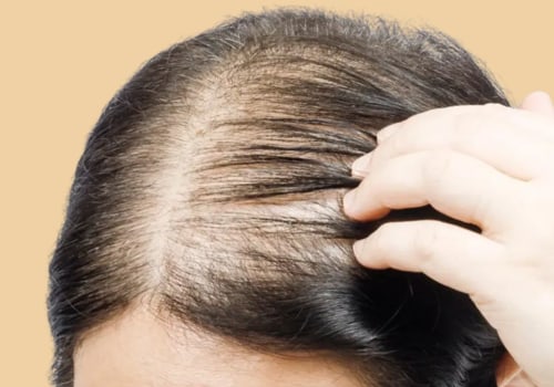 Lifestyle Factors and Female Hair Loss: Understanding the Connection