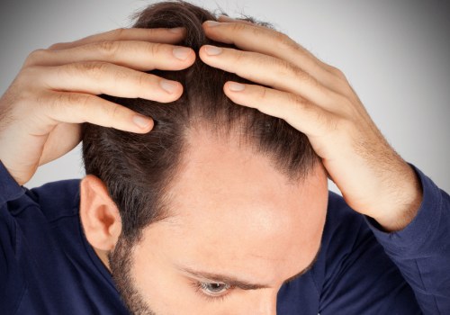 Understanding Hereditary Hair Loss: A Comprehensive Guide