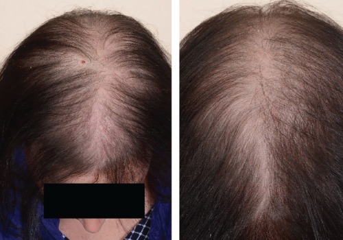 Female Pattern Hair Loss: Understanding the Causes and Genetics