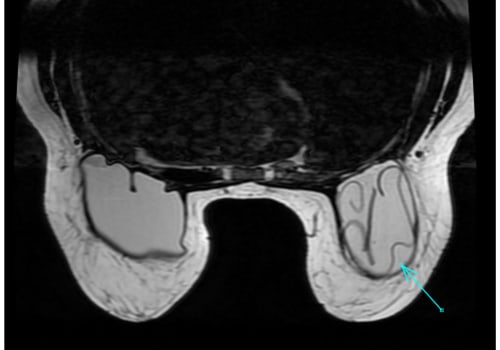 Understanding Implant Rupture and Displacement