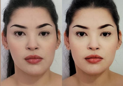 Understanding Asymmetry in Aesthetic Surgery