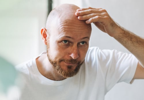 Exploring the Link Between Lifestyle Factors and Male Pattern Baldness