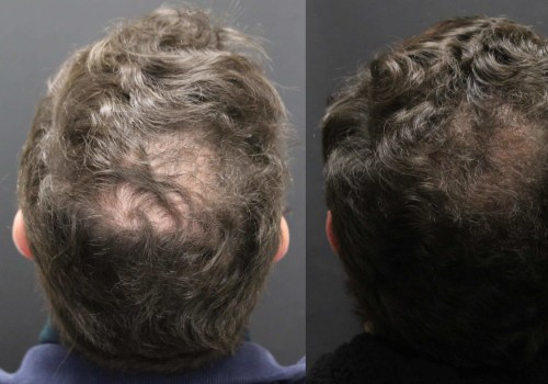 Minoxidil: The Revolutionary Hair Loss Treatment You Need to Know