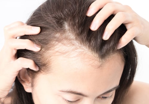 Understanding Female Hair Loss: Causes, Diagnosis, and Treatment