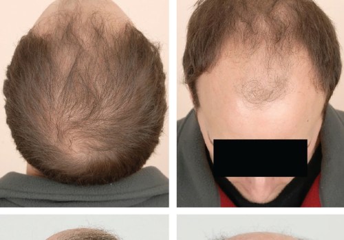 Diagnosing Male Pattern Baldness: A Comprehensive Guide